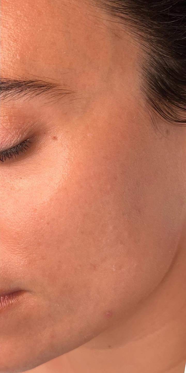 After — Chemical Peel
