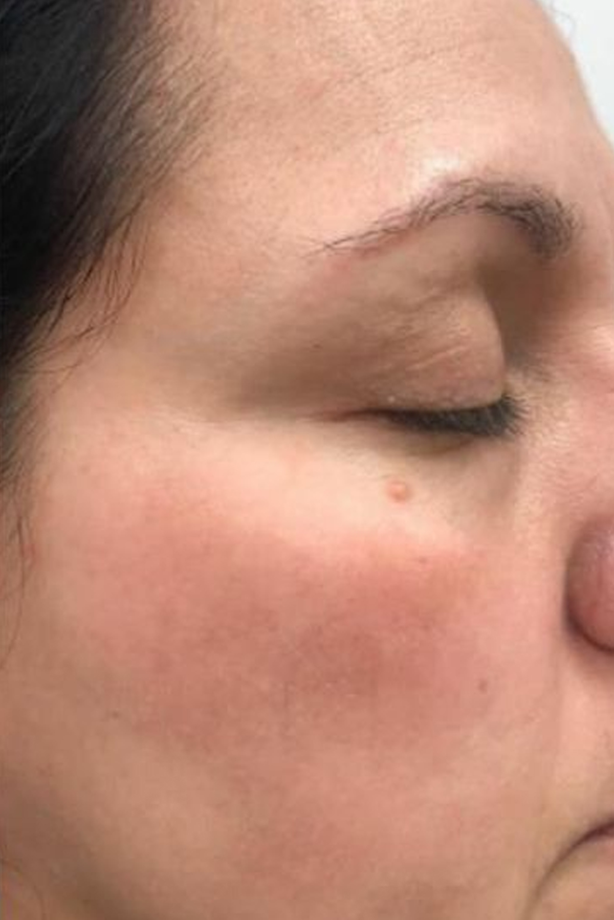 After — Pigmentation Treatment
